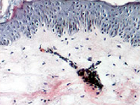 Атипичное протекание затяжной Эпштейн–Барр вирусной инфекции с васкулитом и полиартритом